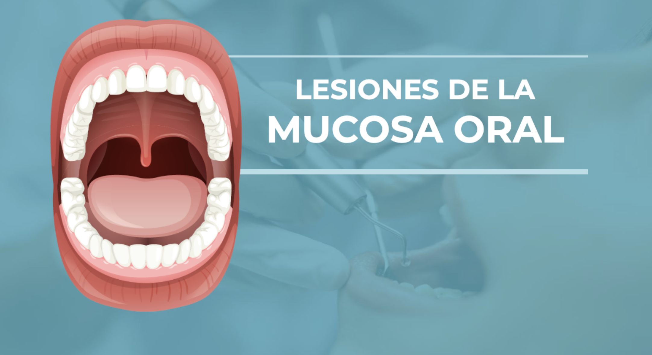 Lesiones de la Mucosa Oral